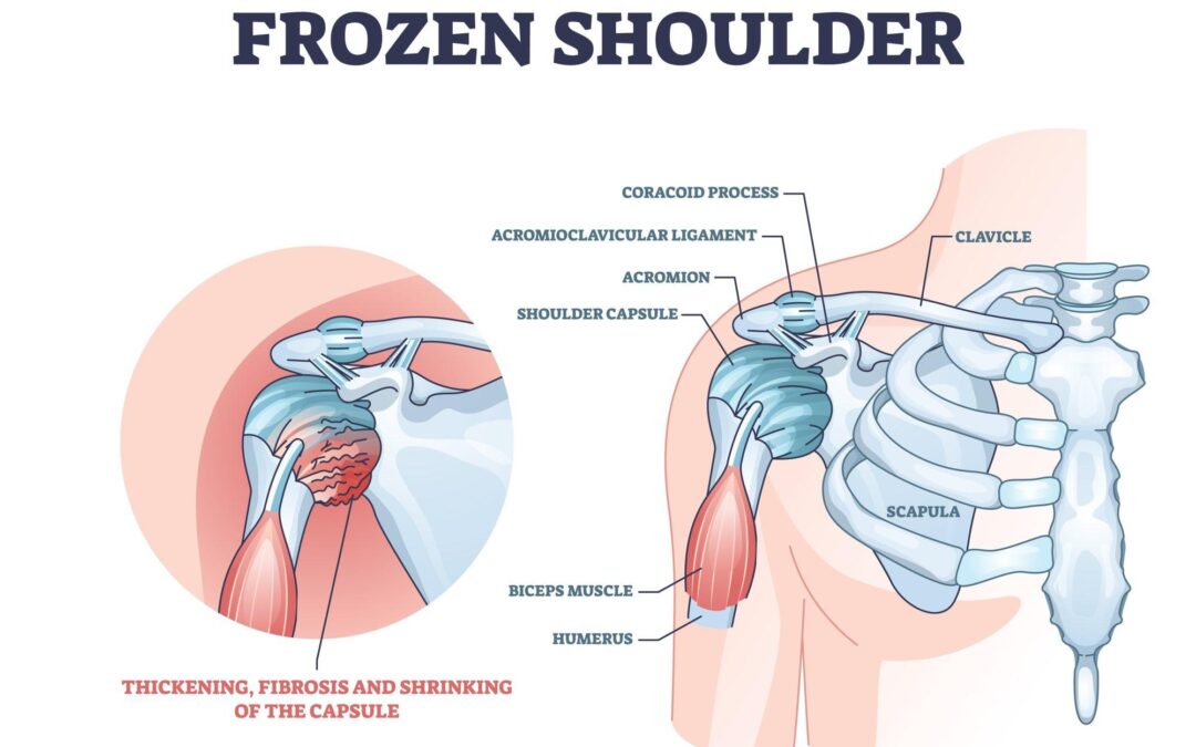 Frozen Shoulder: Physio Exercises That Help